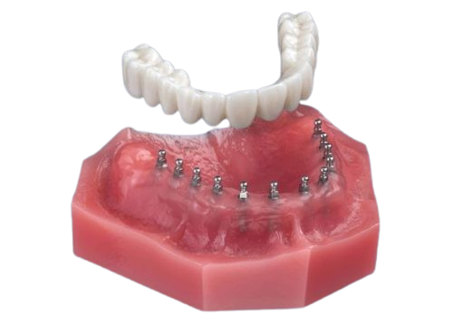 Fixed Dentures in Austin, TX | Ask Us About Mini Dental Implants