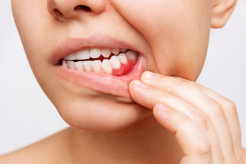 Reverse Gum Disease in Austin, TX | Treat Your Periodontitis